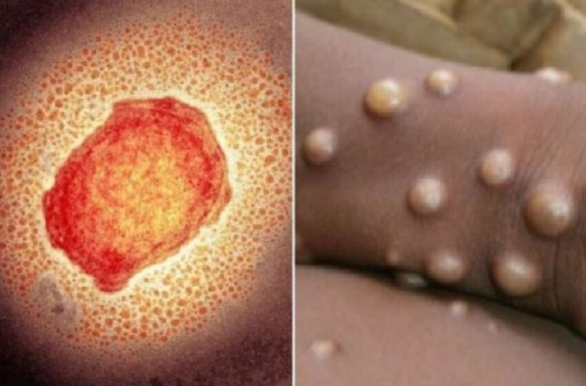  Monkeypox को लेकर भारत में भी बढ़ी चिंता, केंद्र सरकार ने जारी किया अलर्ट | Nation One