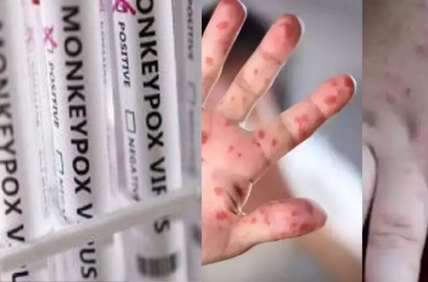  Monkeypox Virus: यूपी के गाजियाबाद में मंकीपॉक्स के दस्तक! 5 साल की बच्ची में दिखे लक्षण, सैंपल जांच के लिए भेजे | Nation One