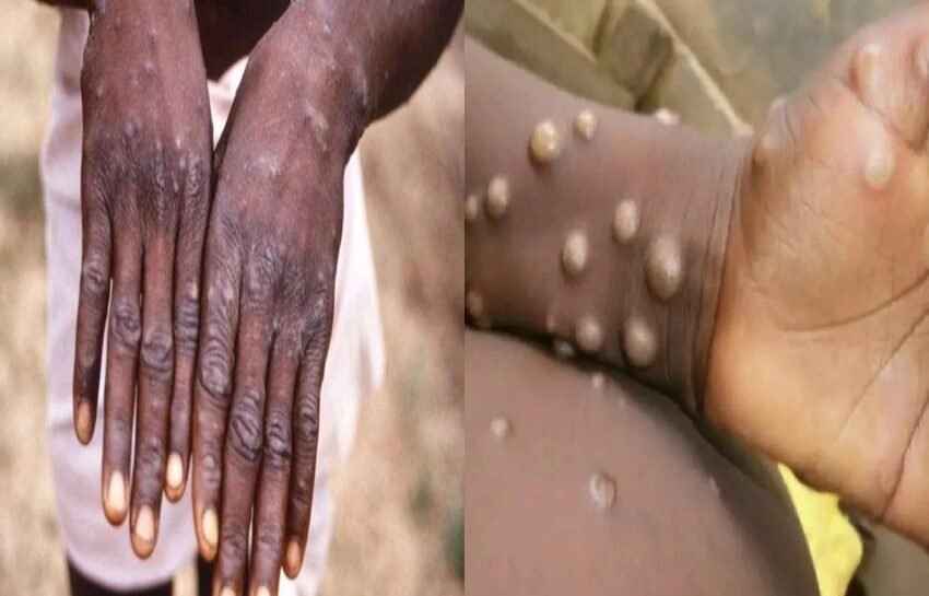  Monkeypox : मंकीपॉक्स वायरस को लेकर रिसर्च में हुए कई और चौंकाने वाले खुलासे, पढ़ें पूरी खबर | Nation One