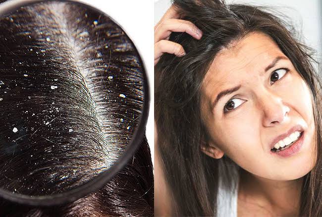  Hair Care Tips : ऑयली स्कैल्प की समस्या से हैं परेशान? तो आज ही अपनाएं ये उपाय, मिलेगा छुटकारा | Nation One